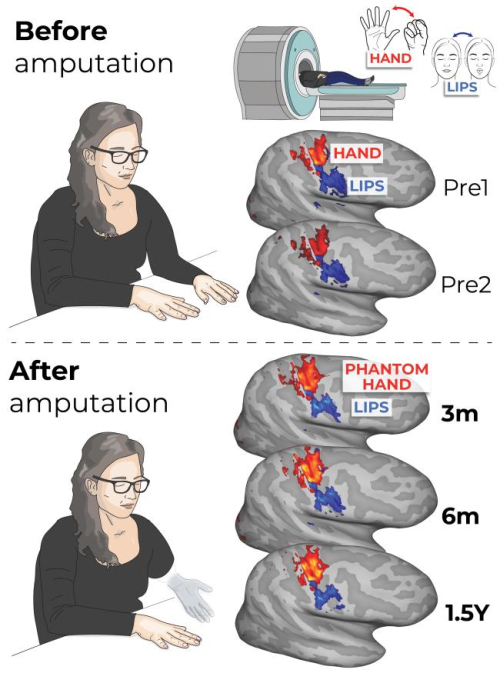 How Phantom Limb Study Rewires Our Understanding of the Brain