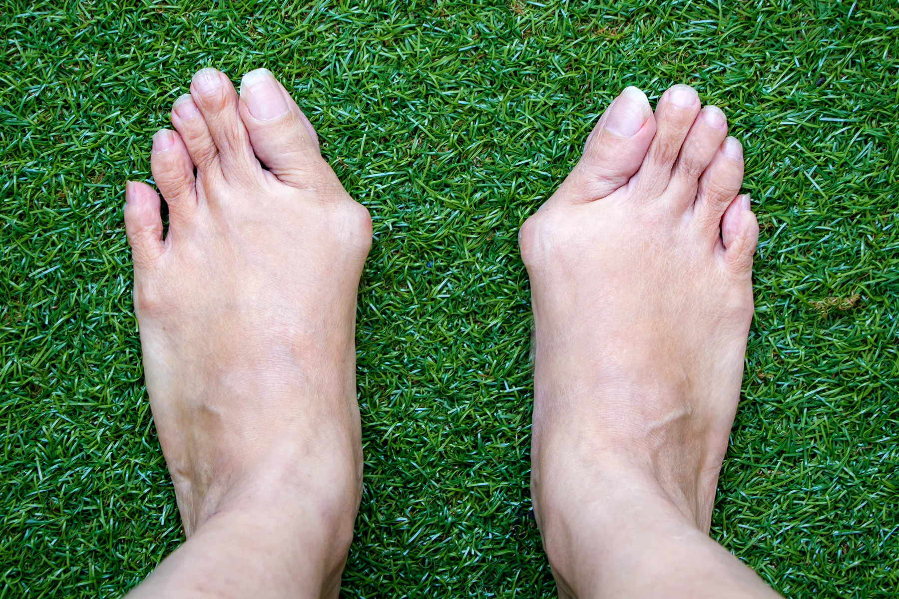 Bunions