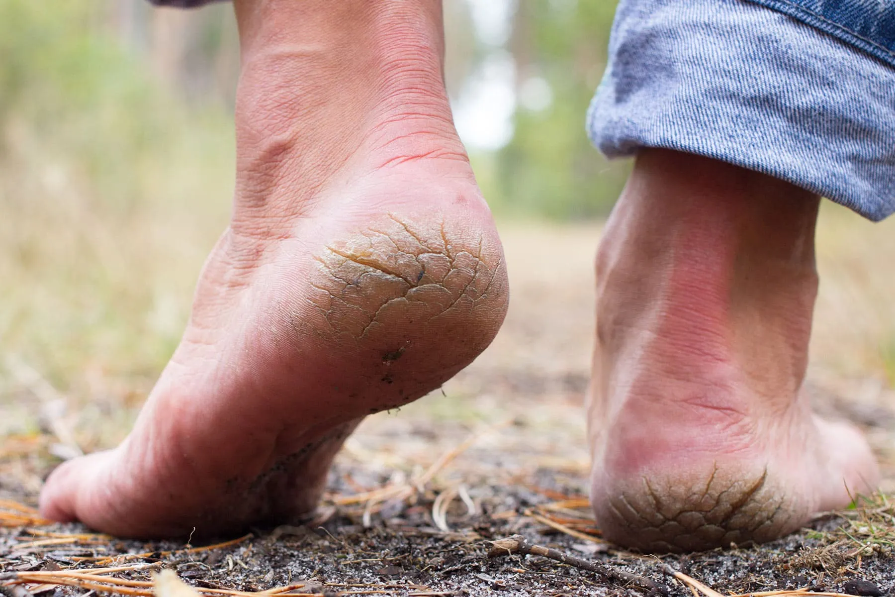 Cracked Heels
