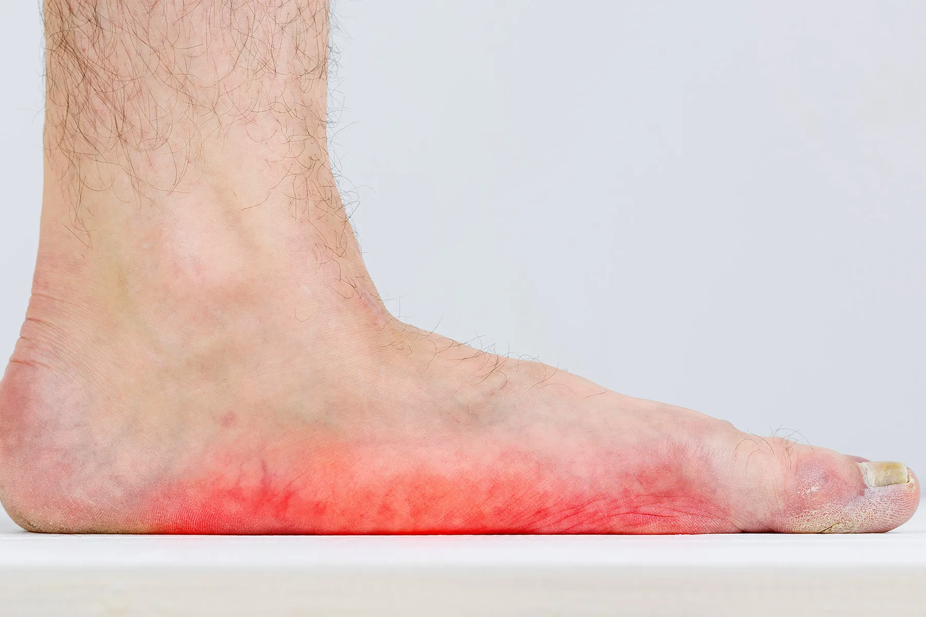 Flat Foot