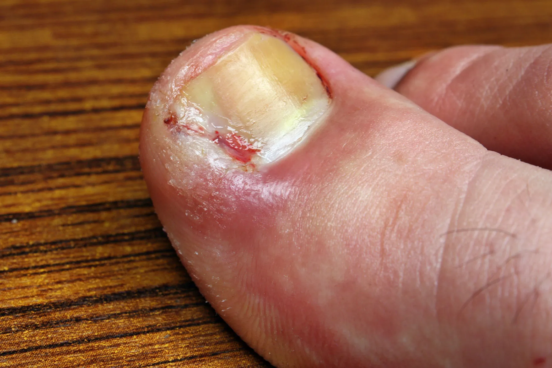 Ingrown Toenails