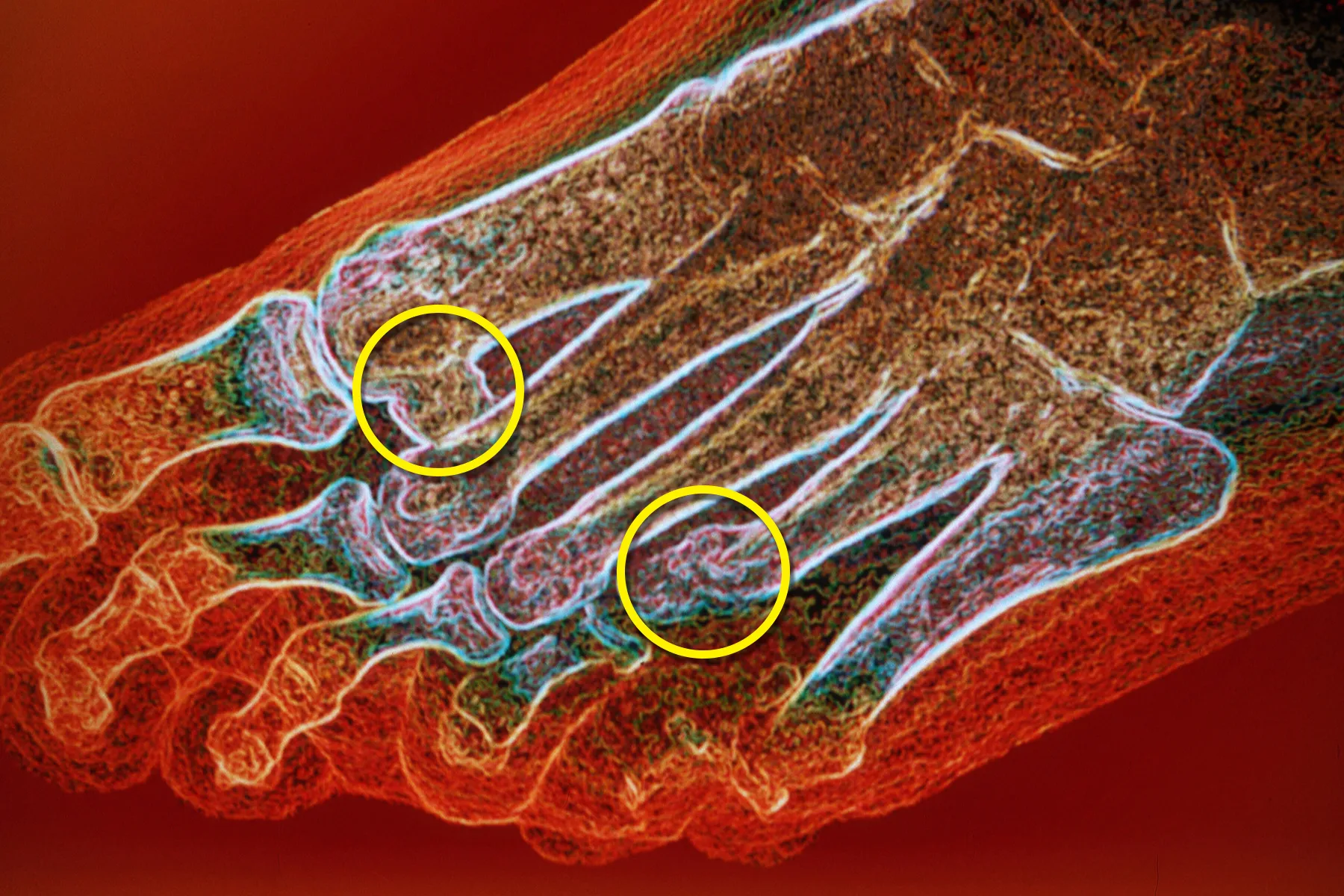 Osteoarthritis