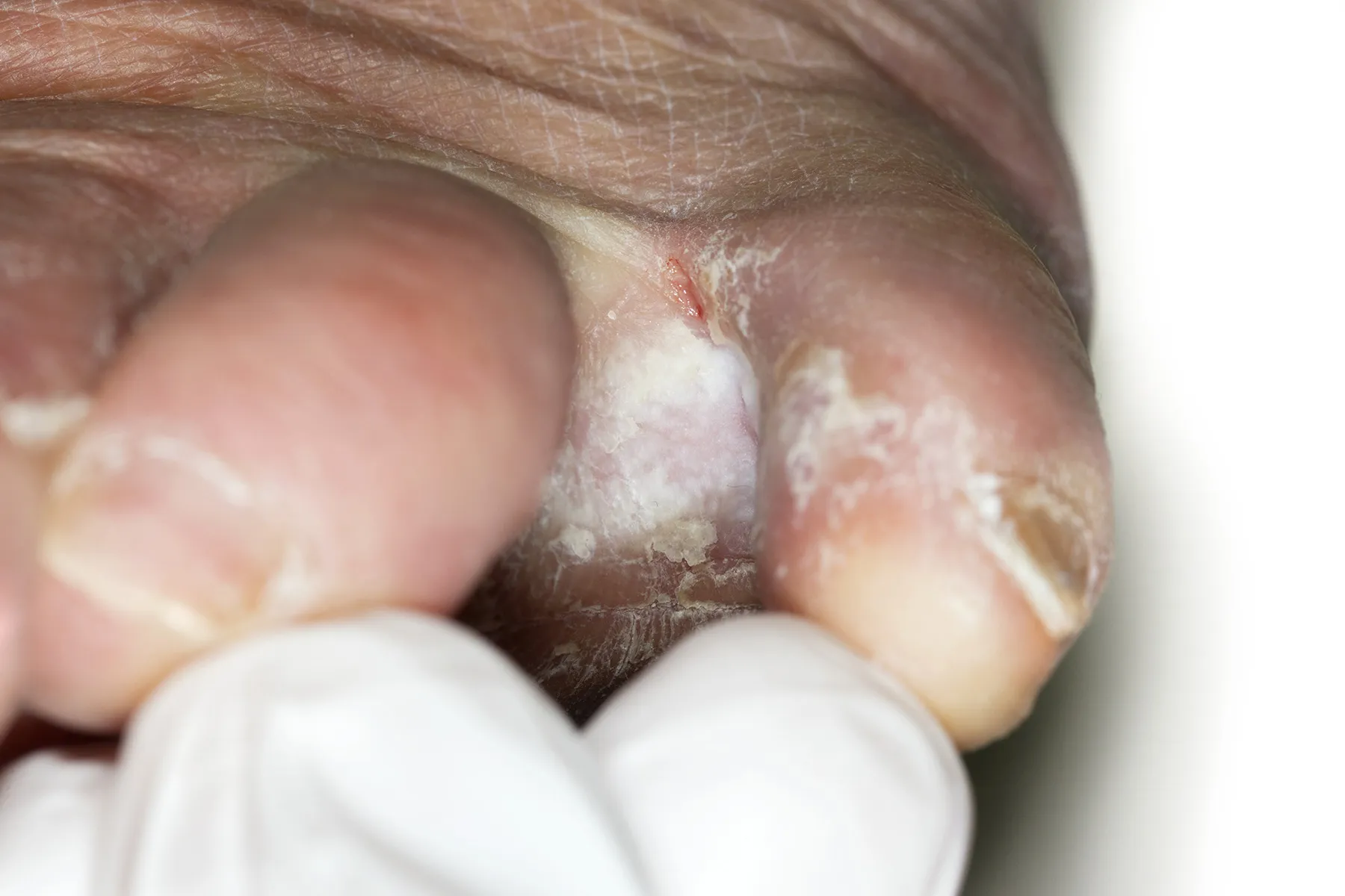 Fungal Infections