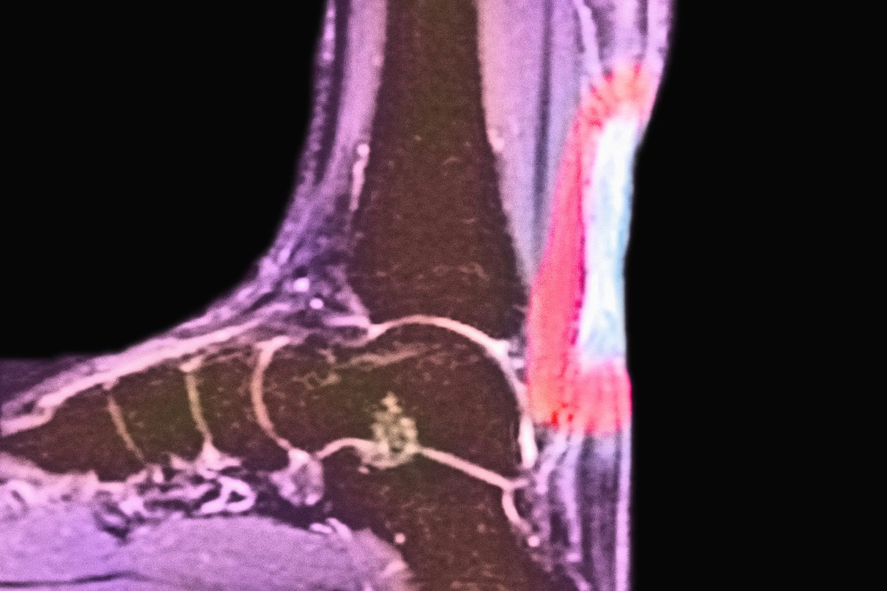 Achilles Tendinitis