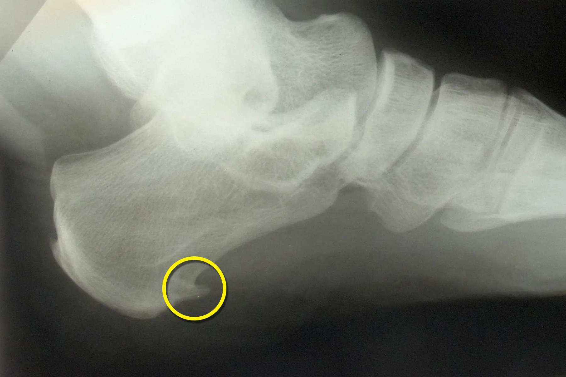 Bone Spurs