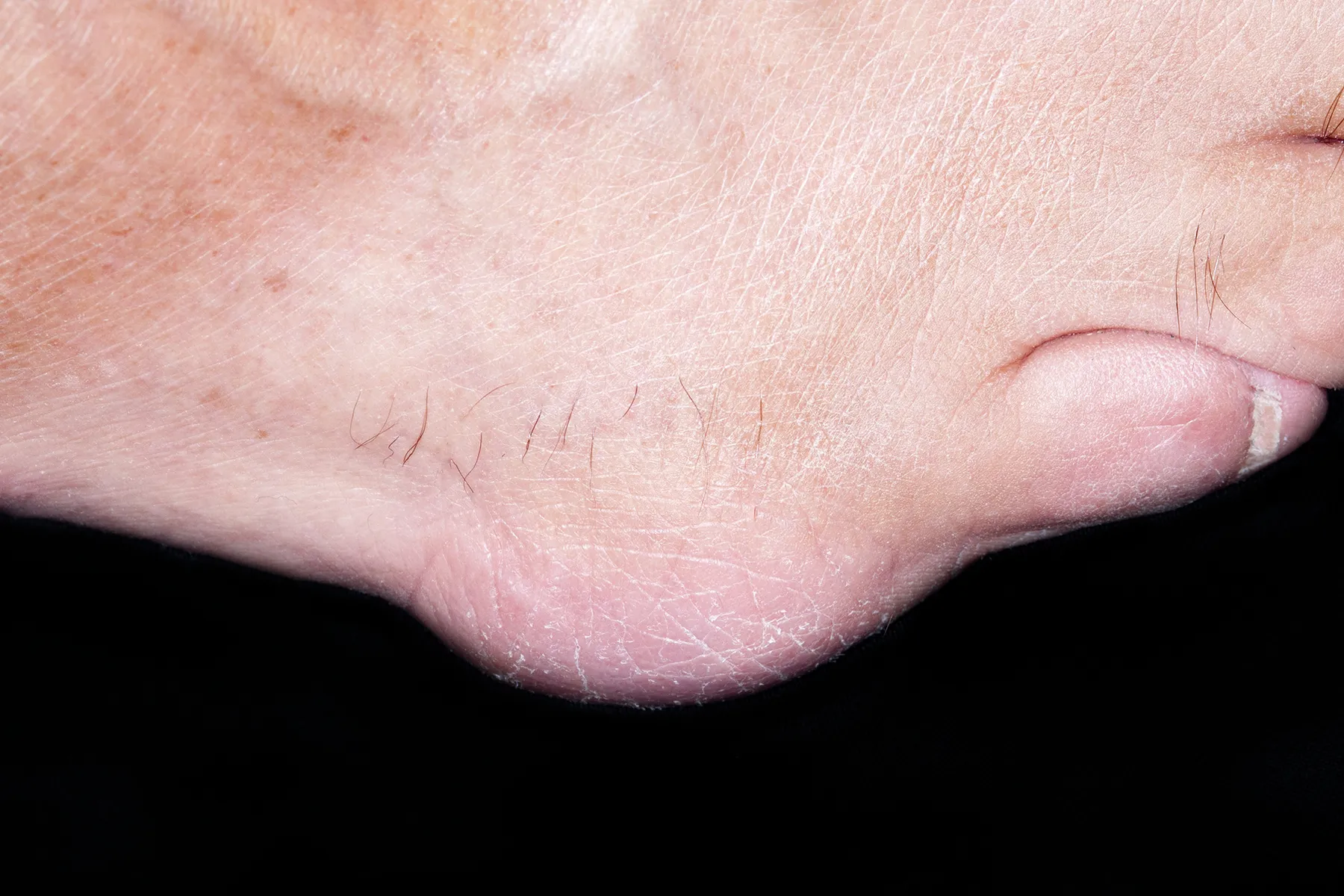 Bursitis