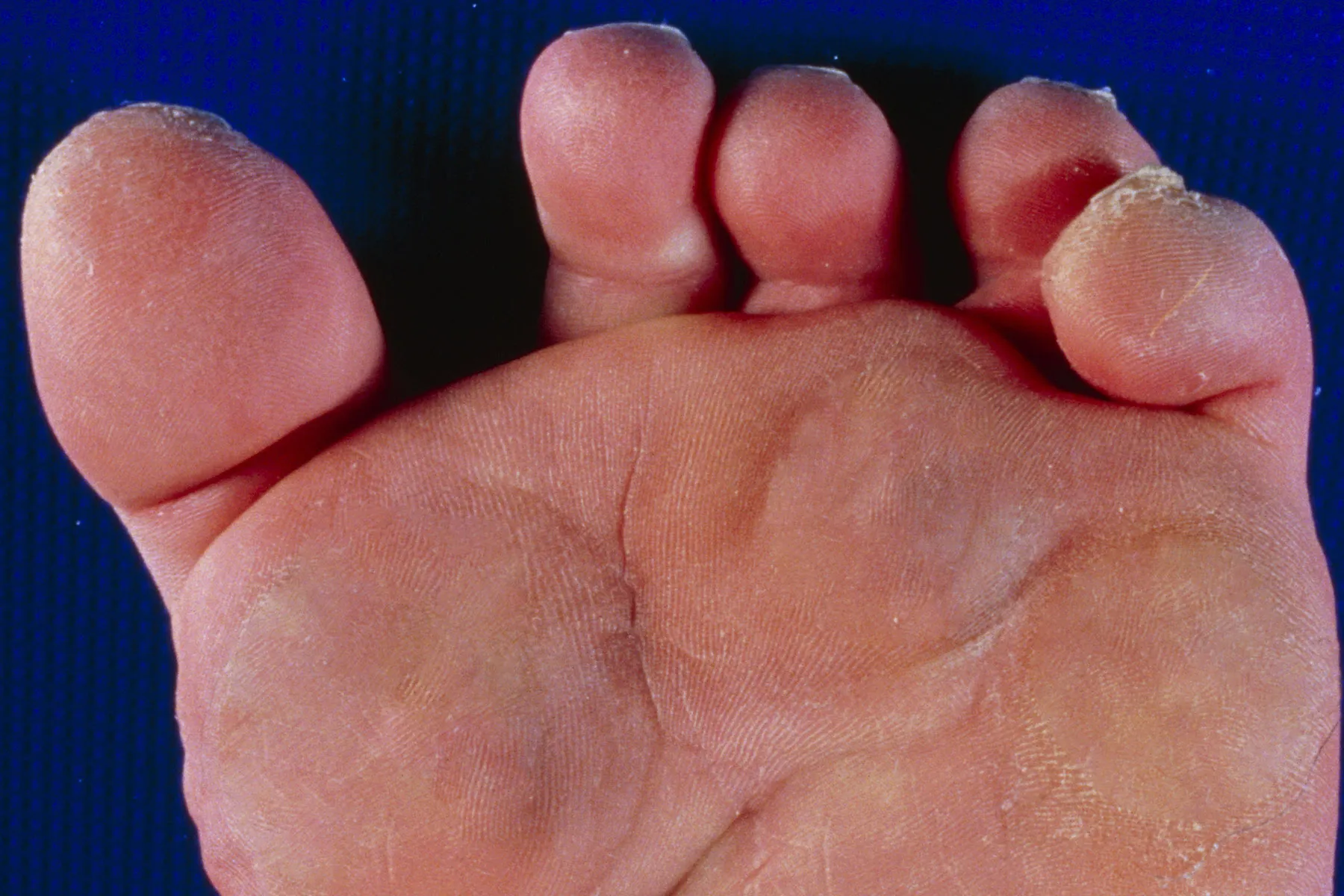 Claw Toe