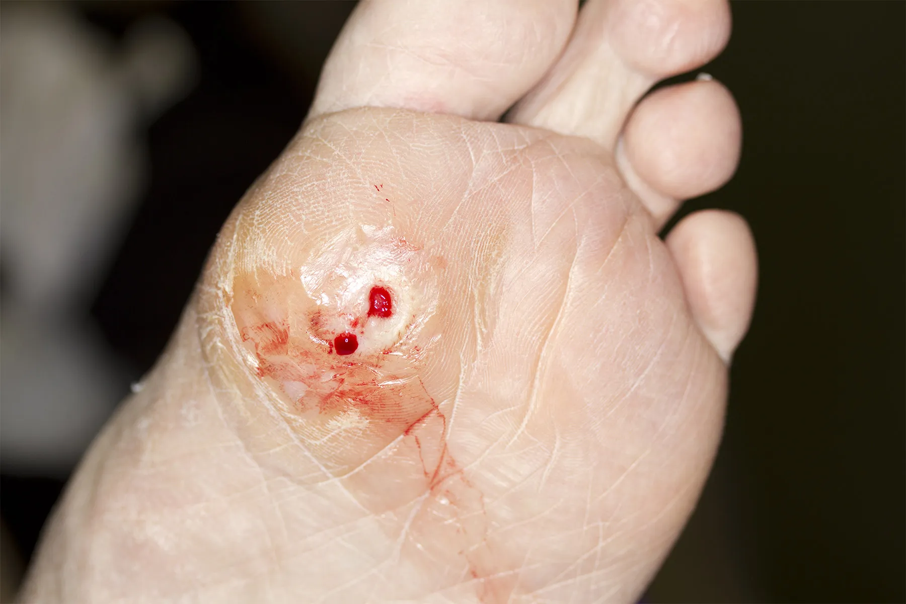 Diabetic Foot Ulcer