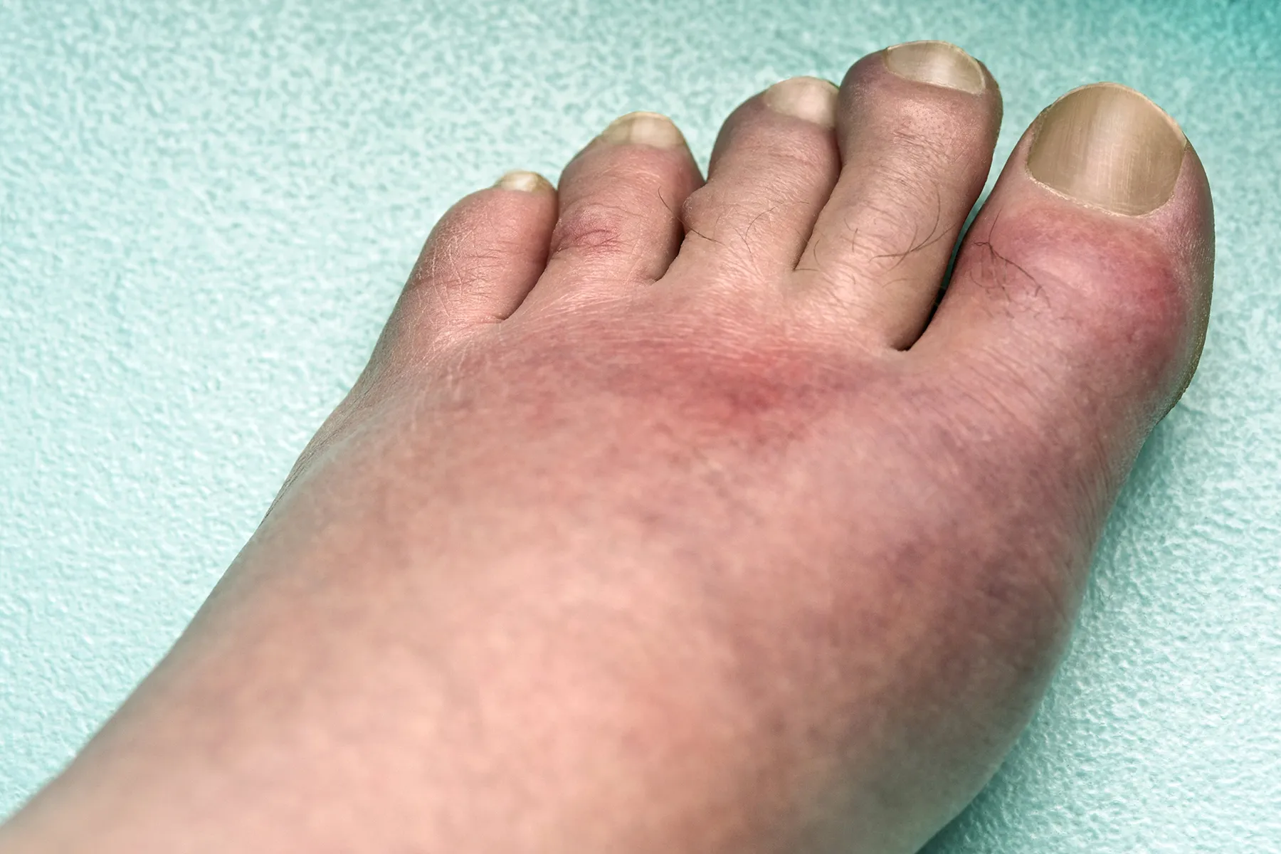 Gout