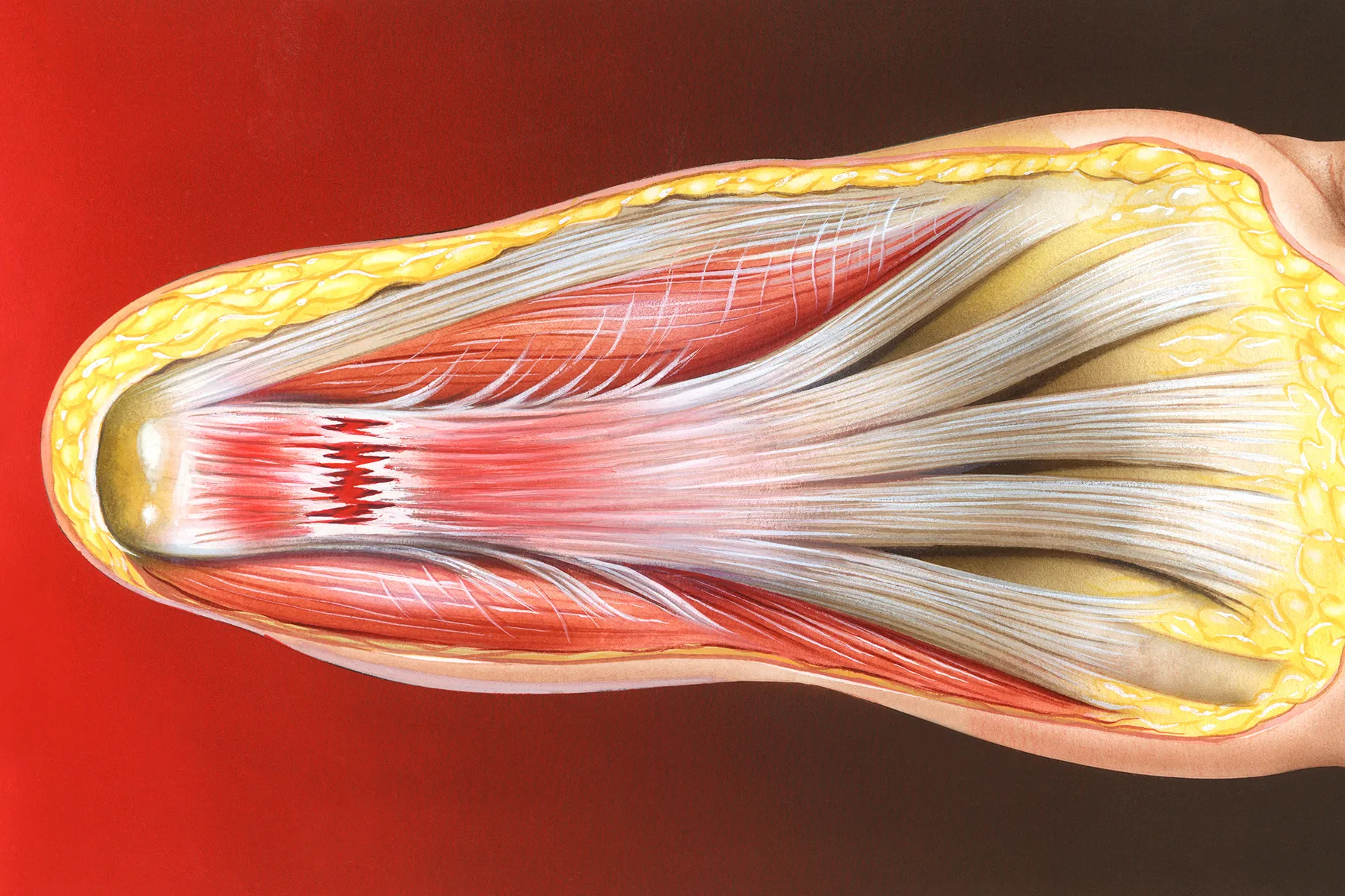 Plantar Fasciitis