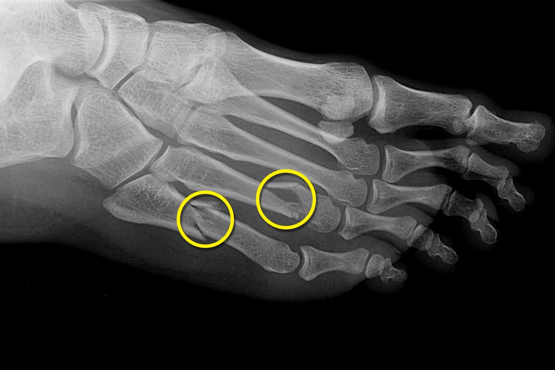 Stress Fractures